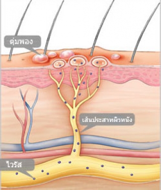 โรคเริม