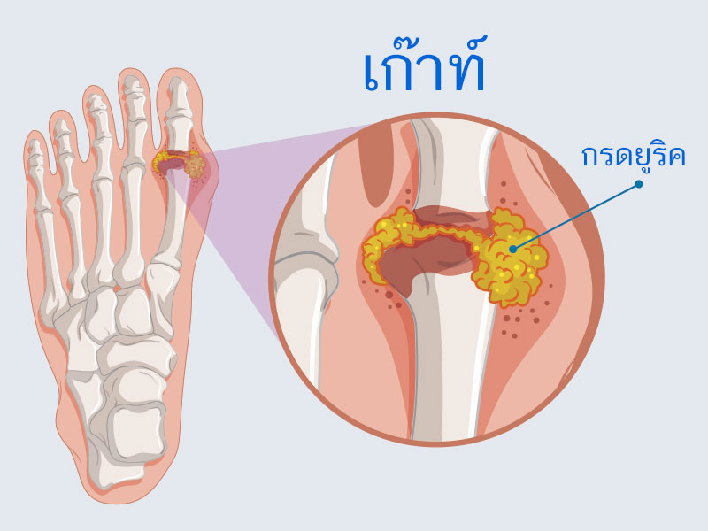 โรคเก๊า