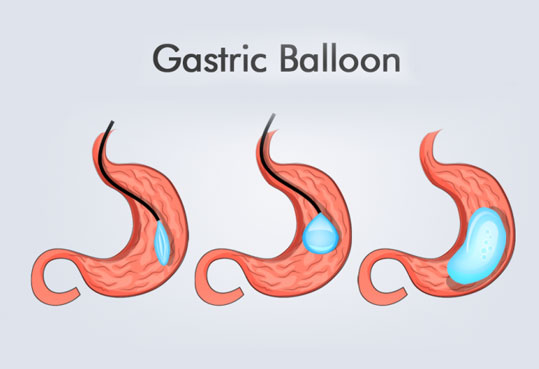 Gastric Balloon